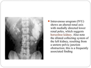 Intravenous urogram (IVU)
shows an altered renal axis
with medially directed lower
renal poles, which suggests
horseshoe kidney. Also note
the dilated collecting system of
the left kidney, resulting from
a uretero pelvic junction
obstruction; this is a frequently
associated finding
 