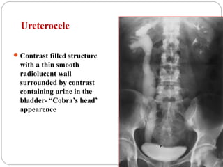 Ureterocele
Contrast filled structure
with a thin smooth
radiolucent wall
surrounded by contrast
containing urine in the
bladder- “Cobra’s head’
appearence
 
