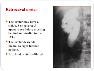 Retrocaval ureter
The ureter may have a
sickle, S or reverse J
appearance before crossing
behind and medial to the
IVC.
The ureter descends
medial to right lumbar
pedicle.
Proximal ureter is dilated.
 