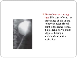 The balloon on a string
sign This sign refers to the
appearance of a high and
somewhat eccentric exit
point of the ureter from a
dilated renal pelvis and is
a typical finding of
ureteropelvic junction
obstruction
 