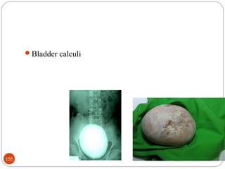 02/09/18155
Bladder calculi
 