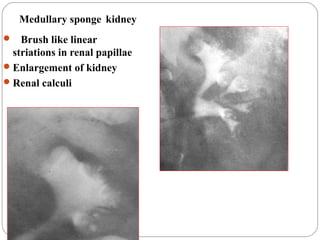 Medullary sponge kidney
 Brush like linear
striations in renal papillae
Enlargement of kidney
Renal calculi
 