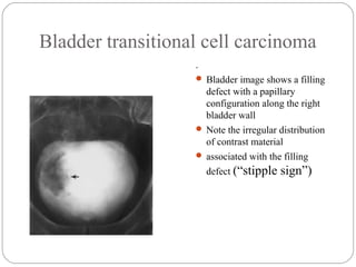 Bladder transitional cell carcinoma
.
 Bladder image shows a filling
defect with a papillary
configuration along the right
bladder wall
 Note the irregular distribution
of contrast material
 associated with the filling
defect (“stipple sign”)
 