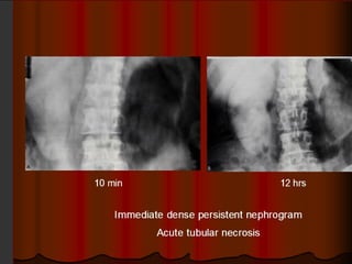 Intravenous Urography