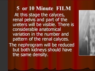Intravenous Urography