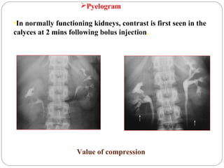 Pyelogram
Value of compression
•In normally functioning kidneys, contrast is first seen in the
calyces at 2 mins following bolus injection.
 