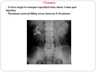 Ureters
Ureters begin to transport opacified urine about 3 mins post
injection
Maximum ureteral filling occurs between 5-10 minutes.
 