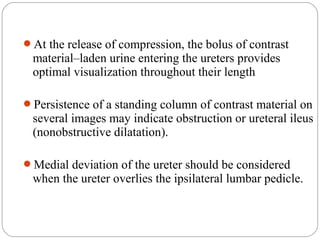 At the release of compression, the bolus of contrast
material–laden urine entering the ureters provides
optimal visualization throughout their length
Persistence of a standing column of contrast material on
several images may indicate obstruction or ureteral ileus
(nonobstructive dilatation).
Medial deviation of the ureter should be considered
when the ureter overlies the ipsilateral lumbar pedicle.
 