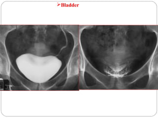 Bladder
 