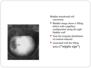Bladder transitional cell
carcinoma.
 Bladder image shows a filling
defect with a papillary
configuration along the right
bladder wall
 Note the irregular distribution
of contrast material
 associated with the filling
defect (“stipple sign”)
 