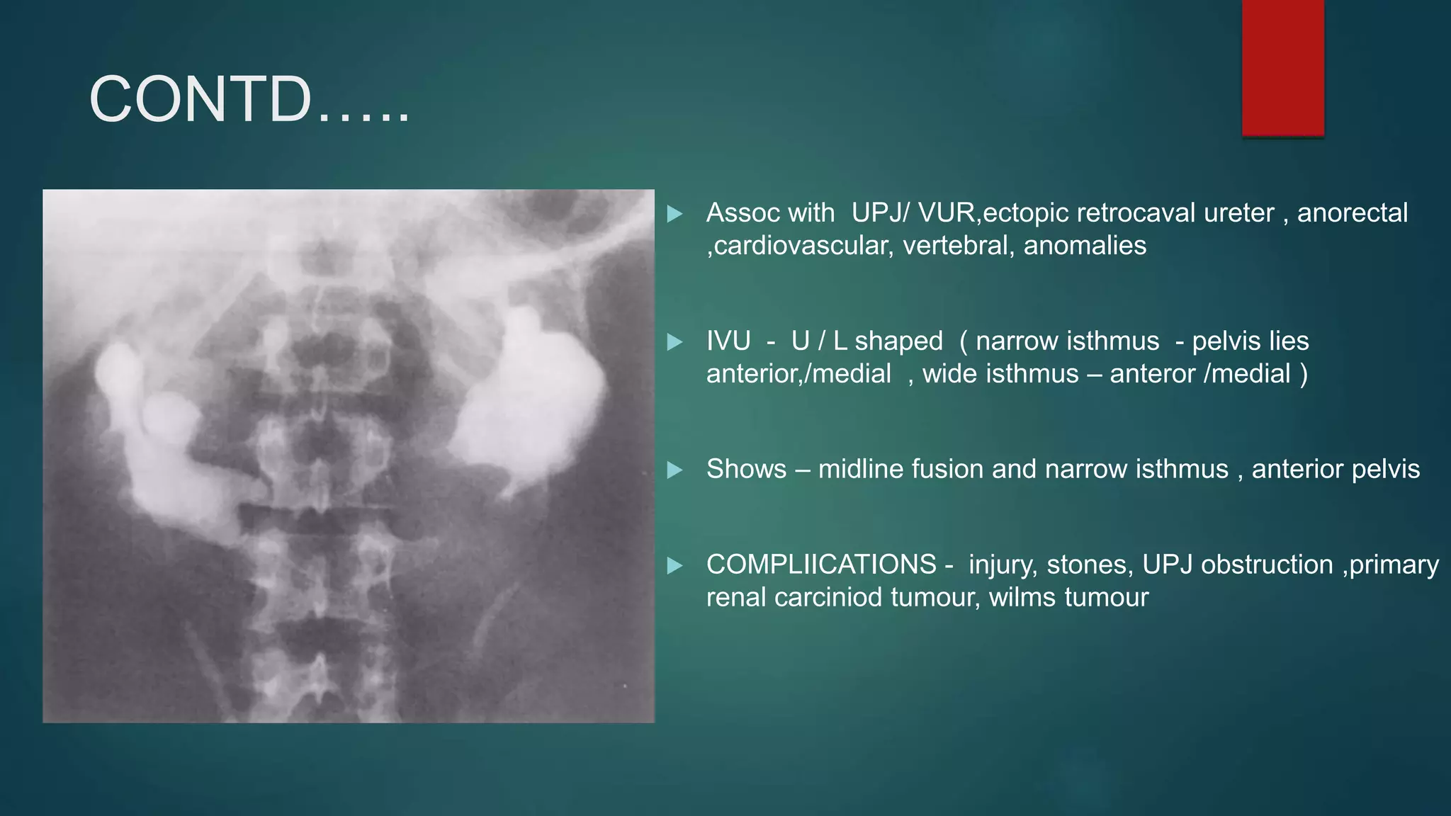 CONTD…..
 Assoc with UPJ/ VUR,ectopic retrocaval ureter , anorectal
,cardiovascular, vertebral, anomalies
 IVU - U / L shaped ( narrow isthmus - pelvis lies
anterior,/medial , wide isthmus – anteror /medial )
 Shows – midline fusion and narrow isthmus , anterior pelvis
 COMPLIICATIONS - injury, stones, UPJ obstruction ,primary
renal carciniod tumour, wilms tumour
 