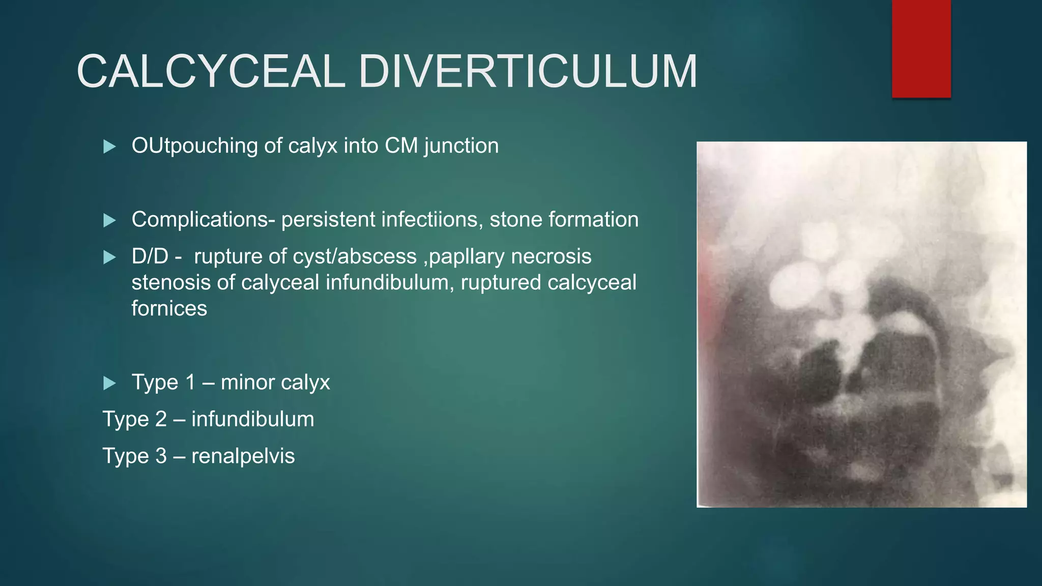 CALCYCEAL DIVERTICULUM
 OUtpouching of calyx into CM junction
 Complications- persistent infectiions, stone formation
 D/D - rupture of cyst/abscess ,papllary necrosis
stenosis of calyceal infundibulum, ruptured calcyceal
fornices
 Type 1 – minor calyx
Type 2 – infundibulum
Type 3 – renalpelvis
 