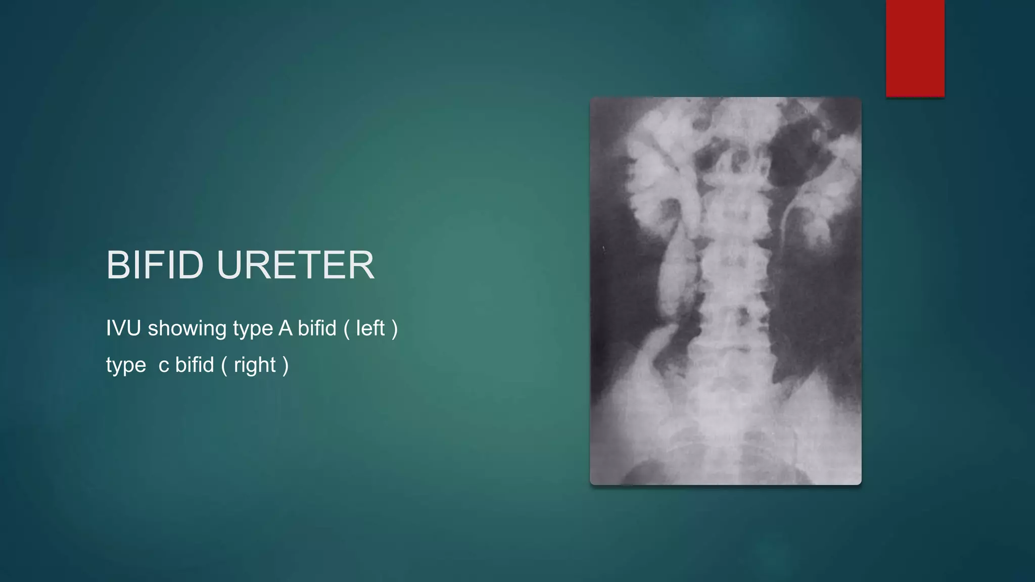 BIFID URETER
IVU showing type A bifid ( left )
type c bifid ( right )
 