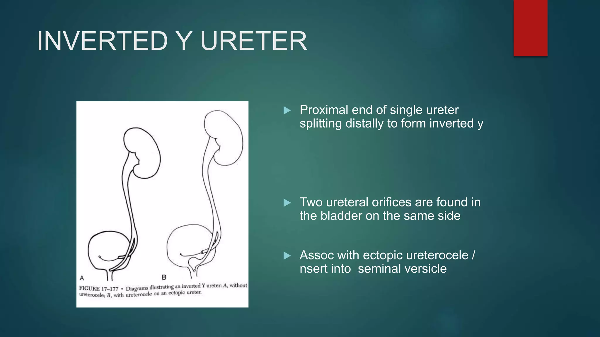 INTRAVENOUS UROGRAM ( IVU ) | PPT