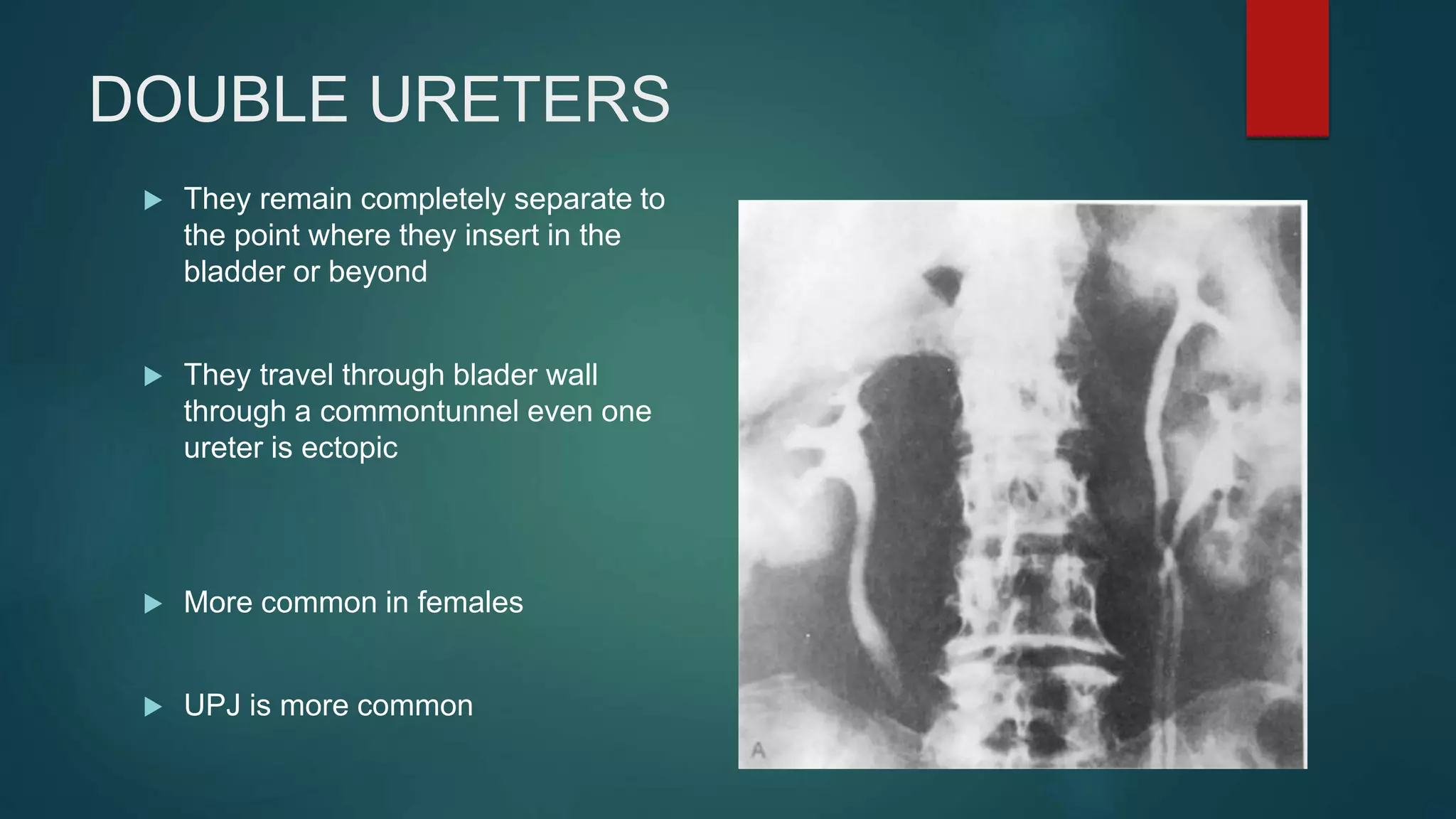 DOUBLE URETERS
 They remain completely separate to
the point where they insert in the
bladder or beyond
 They travel through blader wall
through a commontunnel even one
ureter is ectopic
 More common in females
 UPJ is more common
 