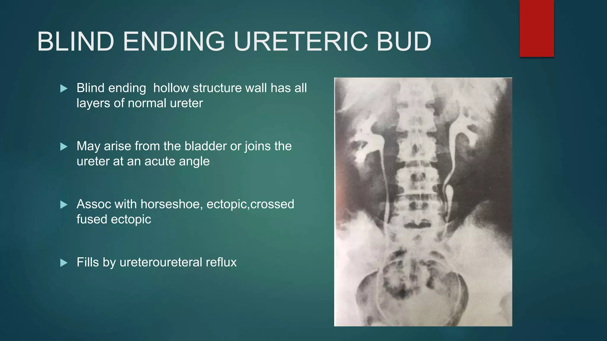 BLIND ENDING URETERIC BUD
 Blind ending hollow structure wall has all
layers of normal ureter
 May arise from the bladder or joins the
ureter at an acute angle
 Assoc with horseshoe, ectopic,crossed
fused ectopic
 Fills by ureteroureteral reflux
 
