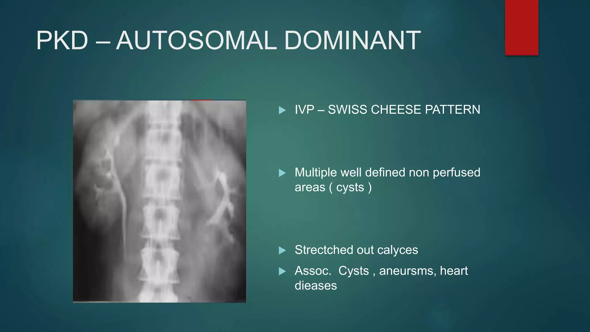 PKD – AUTOSOMAL DOMINANT
 IVP – SWISS CHEESE PATTERN
 Multiple well defined non perfused
areas ( cysts )
 Strectched out calyces
 Assoc. Cysts , aneursms, heart
dieases
 