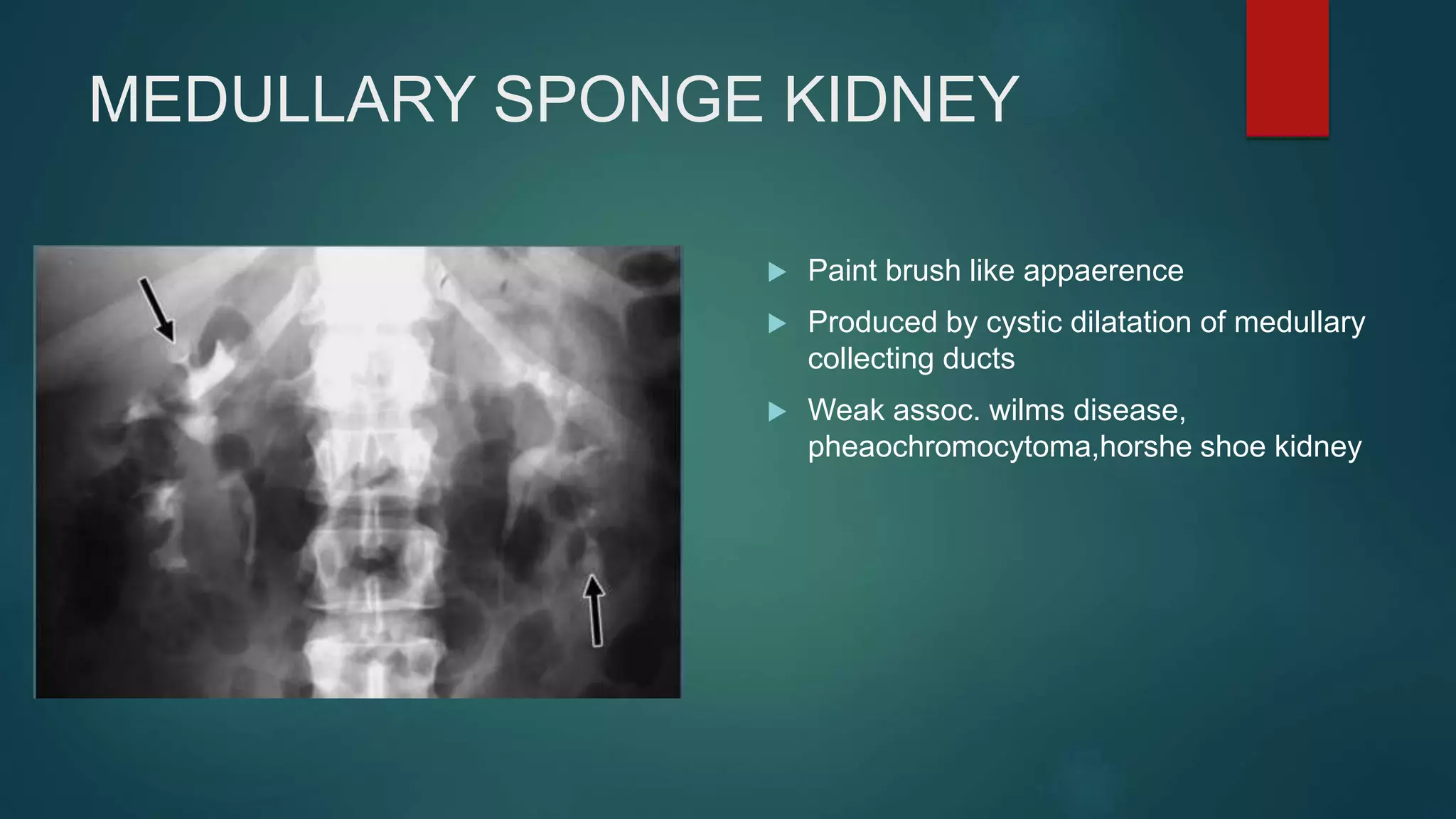 MEDULLARY SPONGE KIDNEY
 Paint brush like appaerence
 Produced by cystic dilatation of medullary
collecting ducts
 Weak assoc. wilms disease,
pheaochromocytoma,horshe shoe kidney
 
