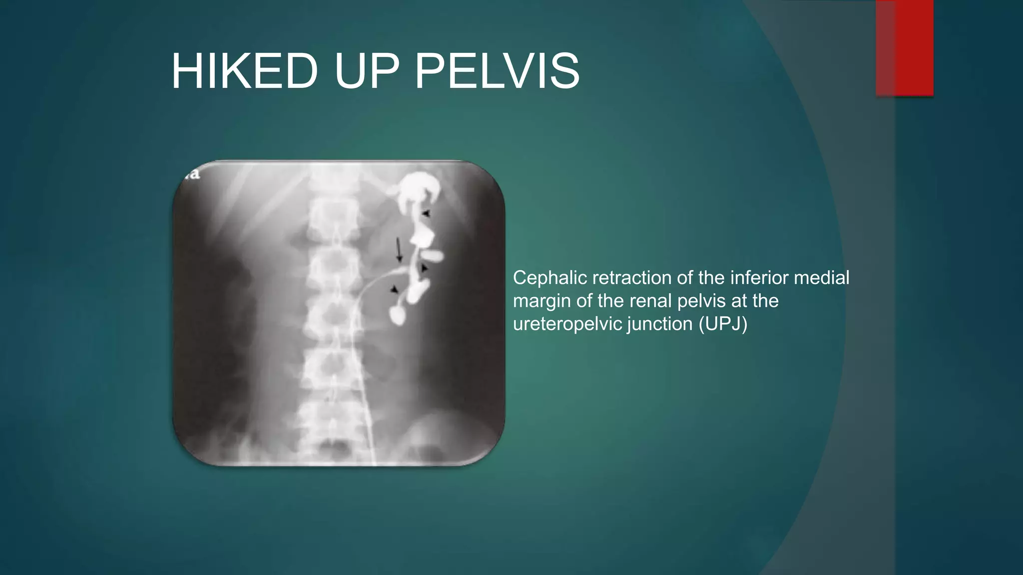 HIKED UP PELVIS
Cephalic retraction of the inferior medial
margin of the renal pelvis at the
ureteropelvic junction (UPJ)
 