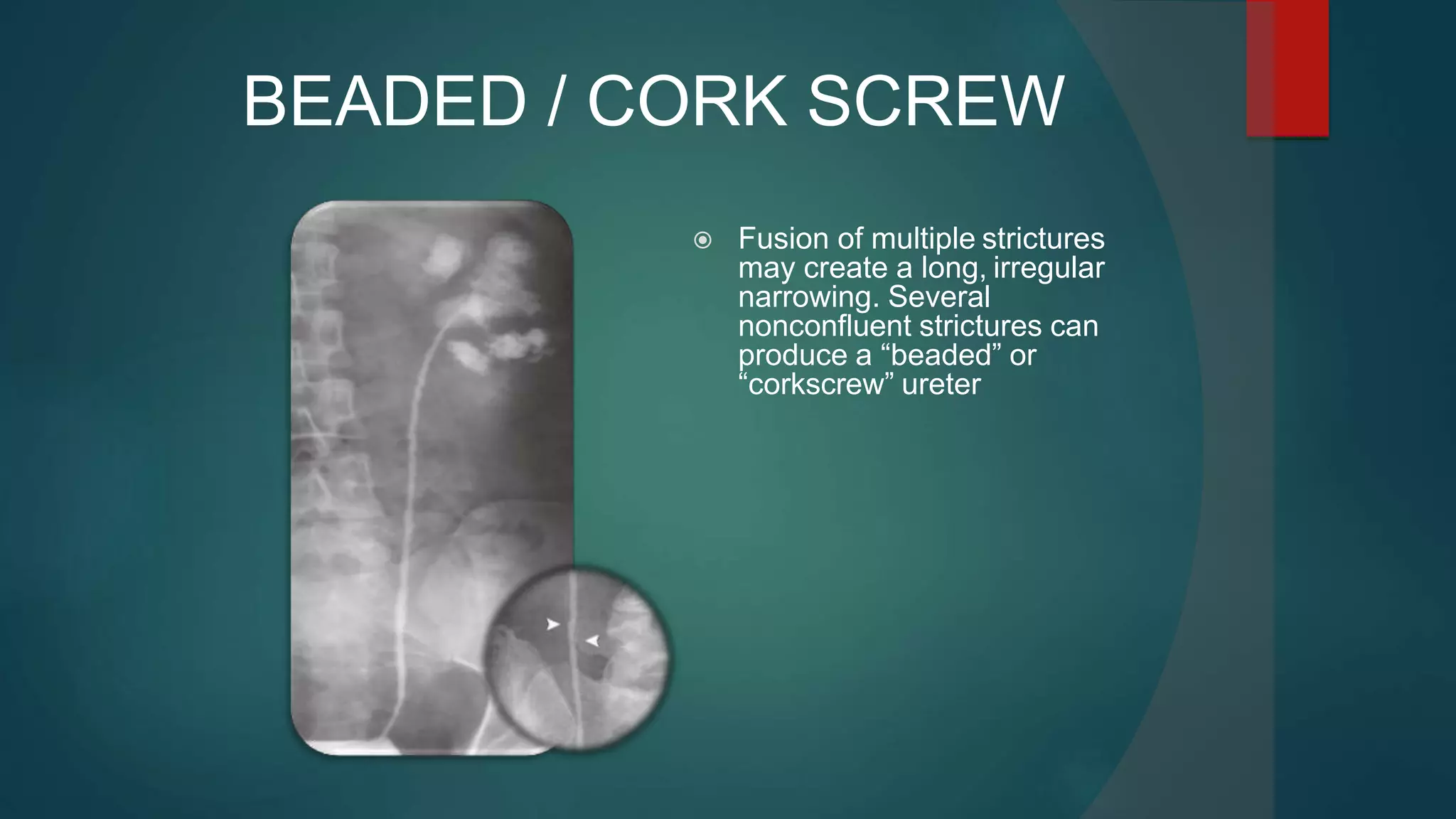  Fusion of multiple strictures
may create a long, irregular
narrowing. Several
nonconfluent strictures can
produce a “beaded” or
“corkscrew” ureter
BEADED / CORK SCREW
 