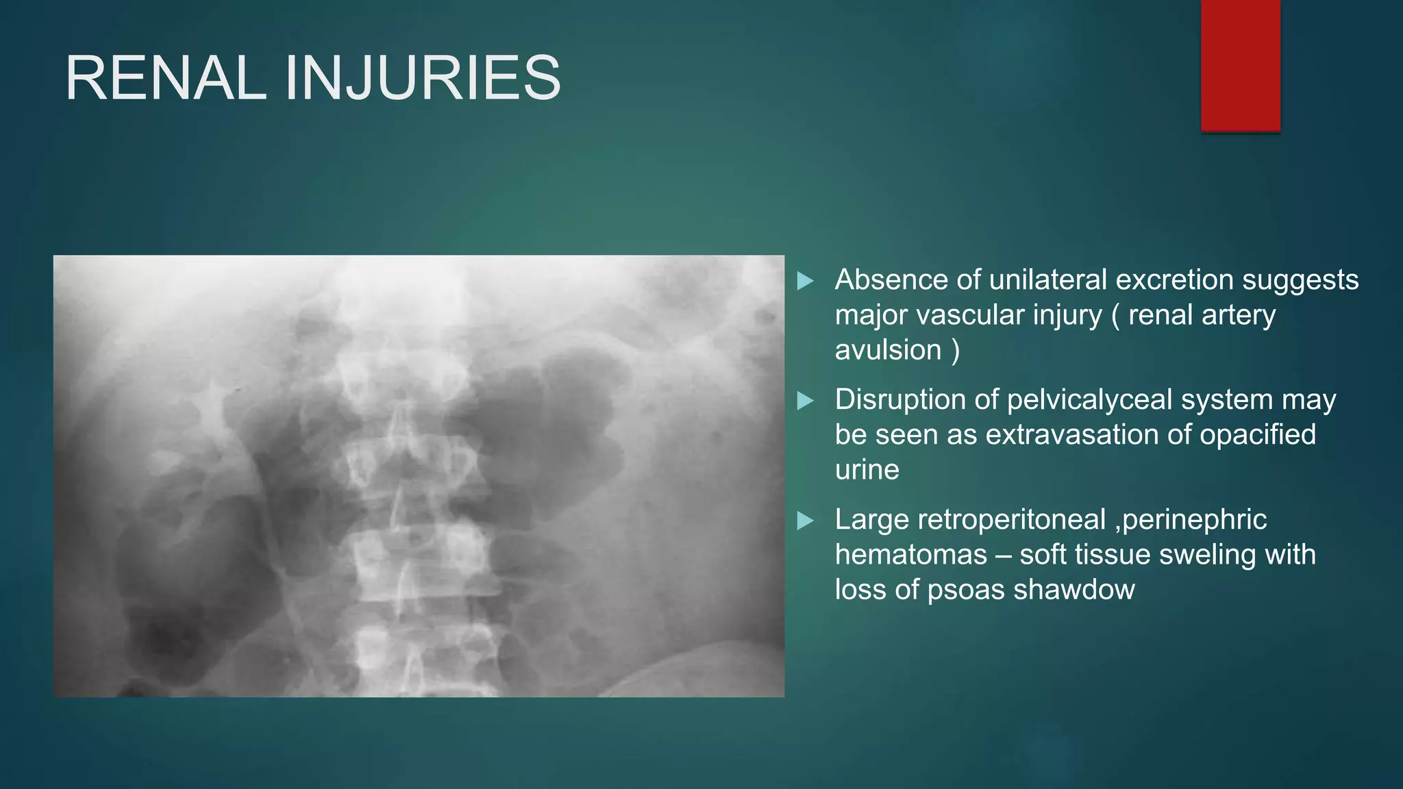 RENAL INJURIES
 Absence of unilateral excretion suggests
major vascular injury ( renal artery
avulsion )
 Disruption of pelvicalyceal system may
be seen as extravasation of opacified
urine
 Large retroperitoneal ,perinephric
hematomas – soft tissue sweling with
loss of psoas shawdow
 
