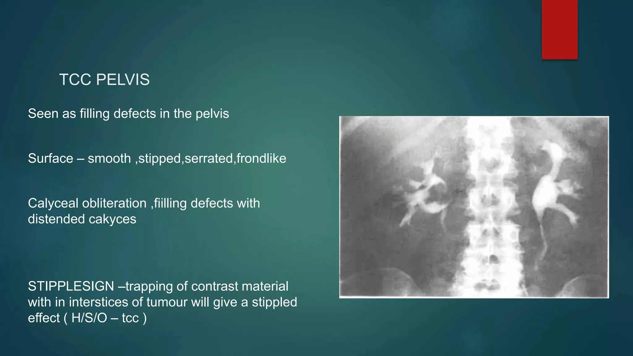 Seen as filling defects in the pelvis
Surface – smooth ,stipped,serrated,frondlike
Calyceal obliteration ,fiilling defects with
distended cakyces
STIPPLESIGN –trapping of contrast material
with in interstices of tumour will give a stippled
effect ( H/S/O – tcc )
TCC PELVIS
 