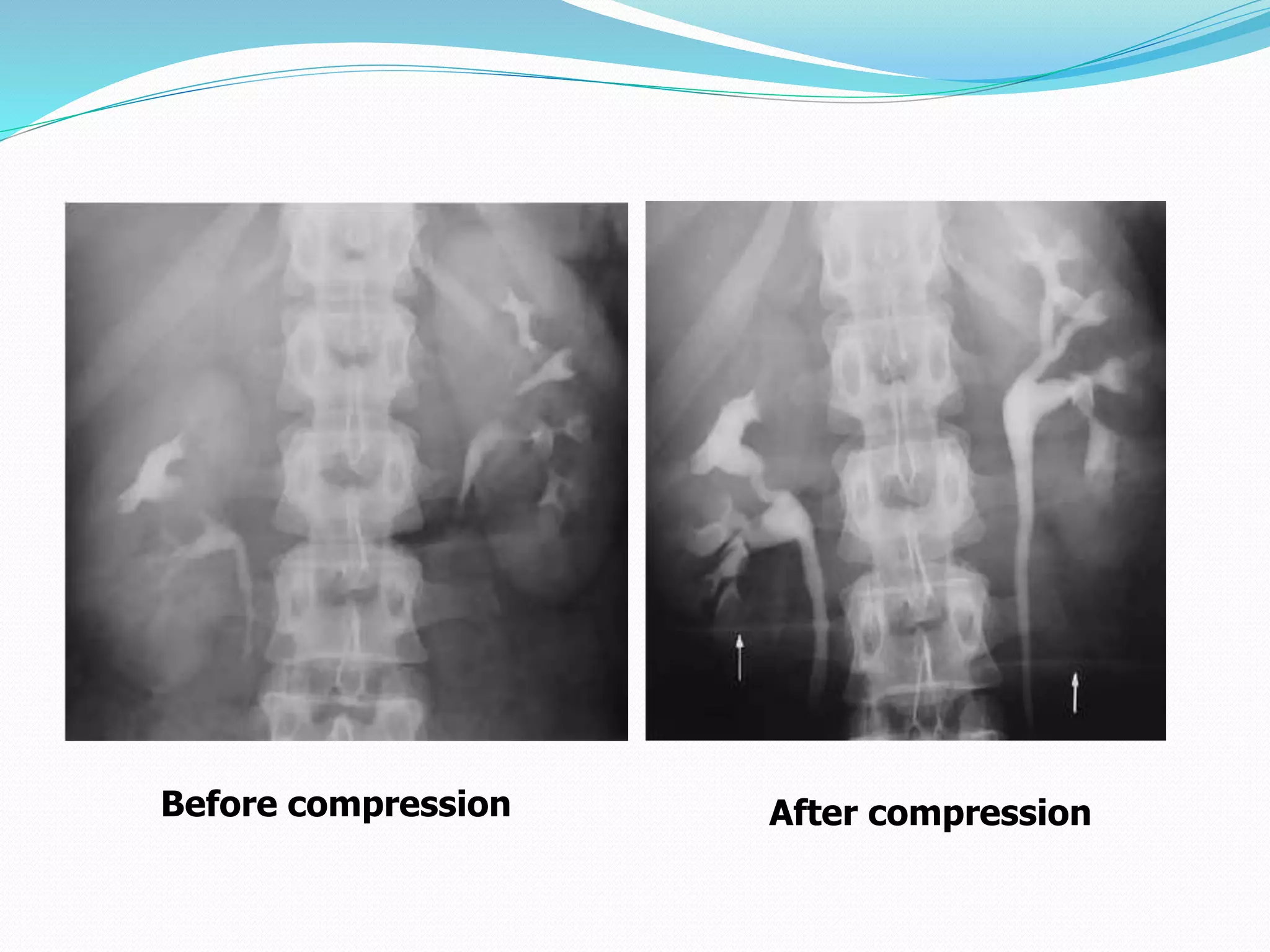 Before compression After compression
 