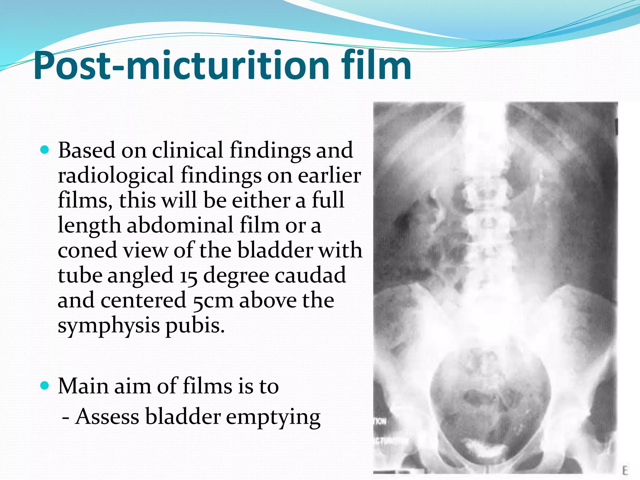 Post-micturition film
 Based on clinical findings and
radiological findings on earlier
films, this will be either a full
length abdominal film or a
coned view of the bladder with
tube angled 15 degree caudad
and centered 5cm above the
symphysis pubis.
 Main aim of films is to
- Assess bladder emptying
 
