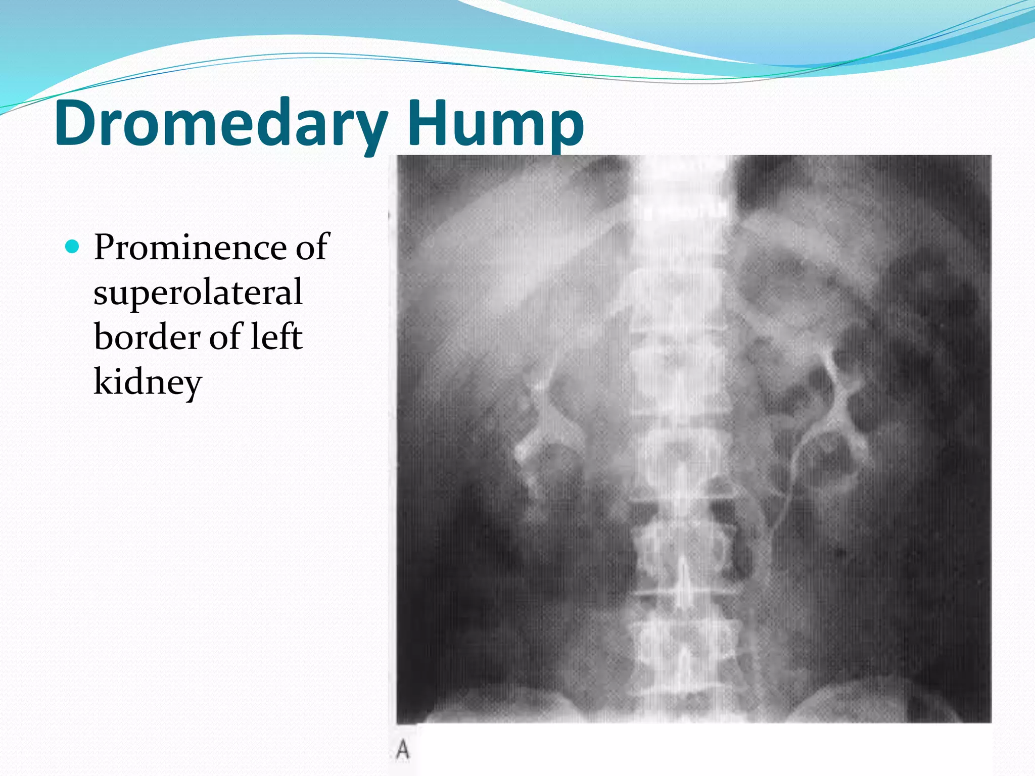Dromedary Hump
 Prominence of
superolateral
border of left
kidney
 