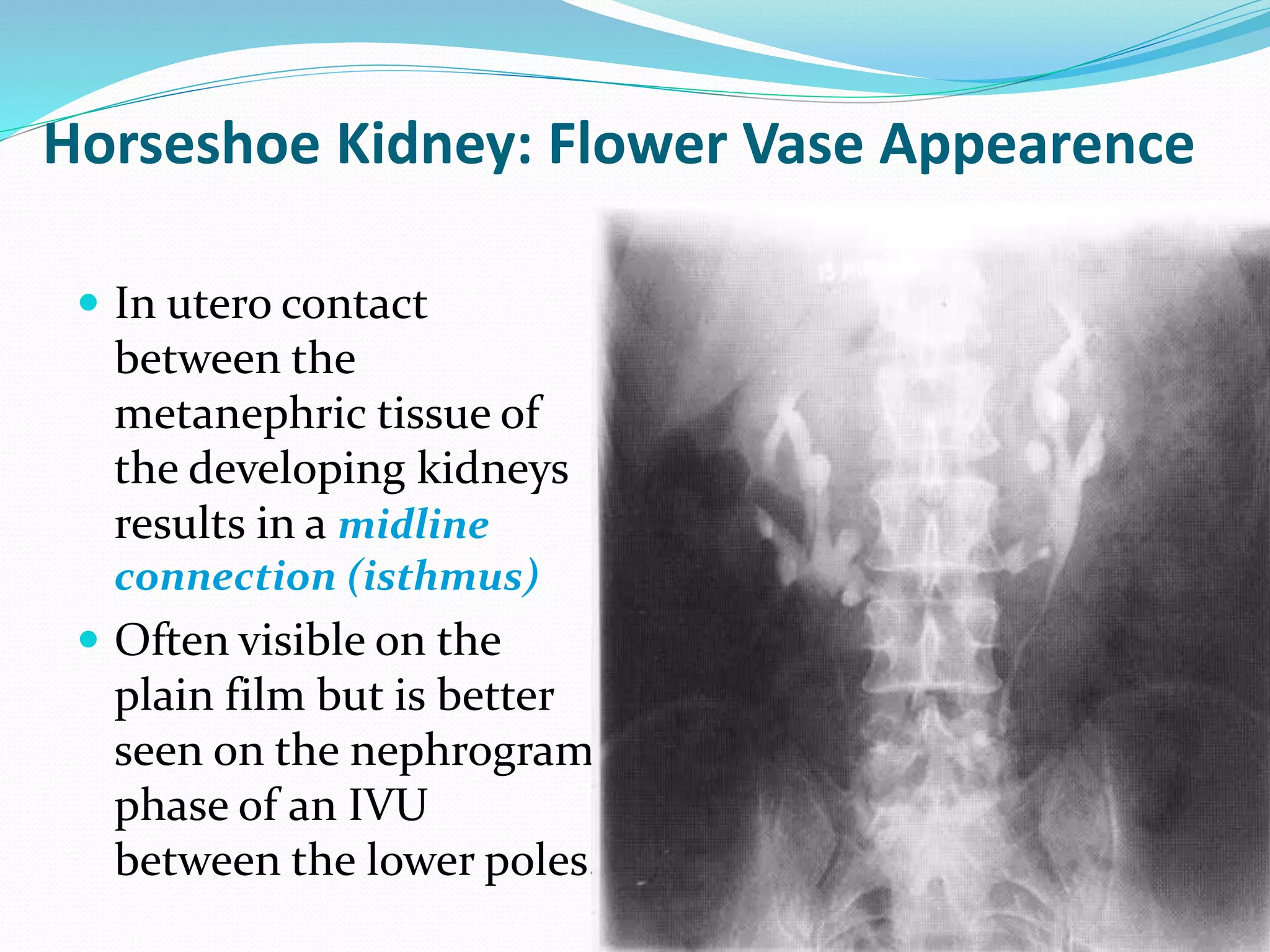 Horseshoe Kidney: Flower Vase Appearence
 In utero contact
between the
metanephric tissue of
the developing kidneys
results in a midline
connection (isthmus)
 Often visible on the
plain film but is better
seen on the nephrogram
phase of an IVU
between the lower poles.
 