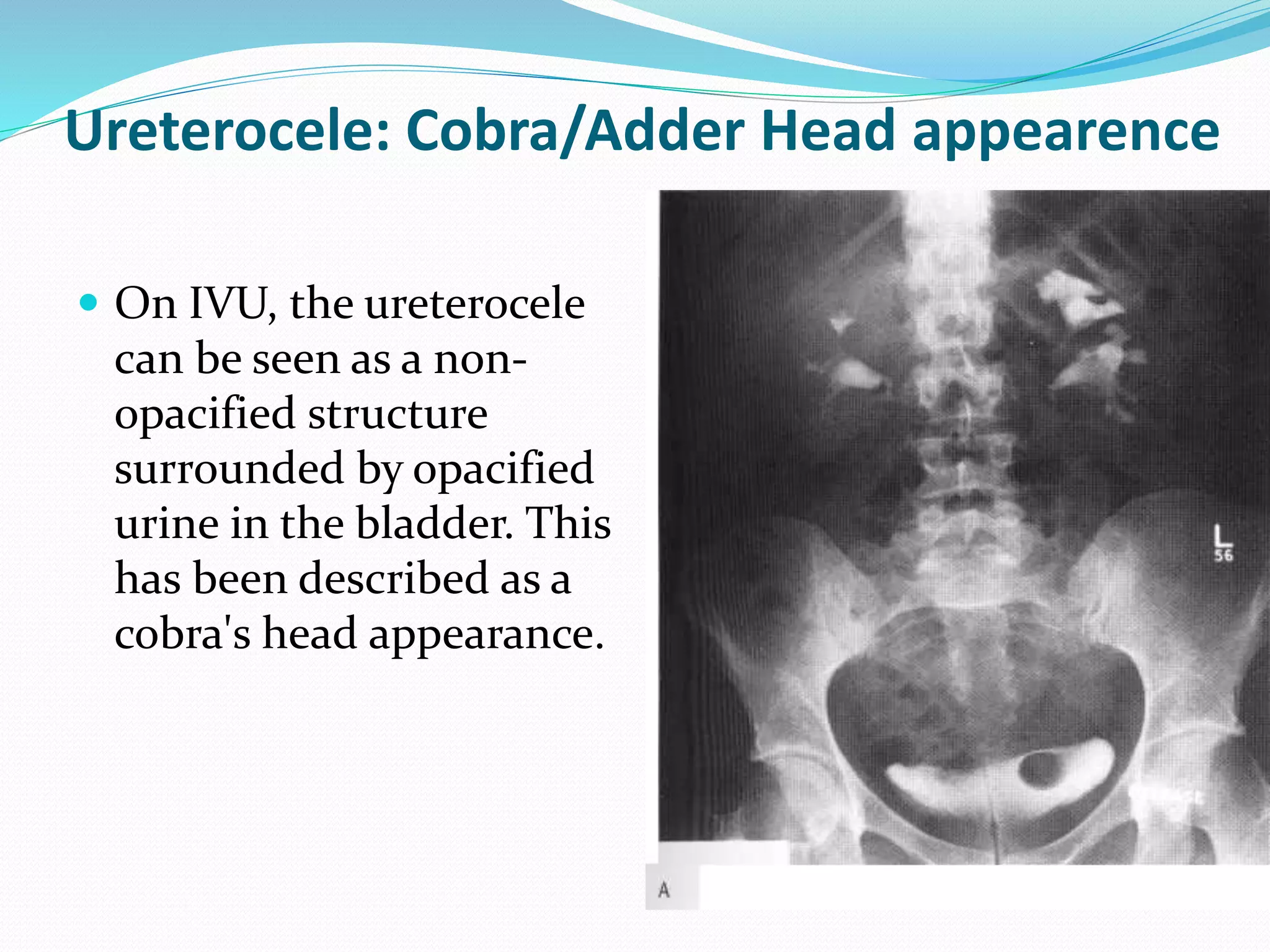 Ureterocele: Cobra/Adder Head appearence
 On IVU, the ureterocele
can be seen as a non-
opacified structure
surrounded by opacified
urine in the bladder. This
has been described as a
cobra's head appearance.
 