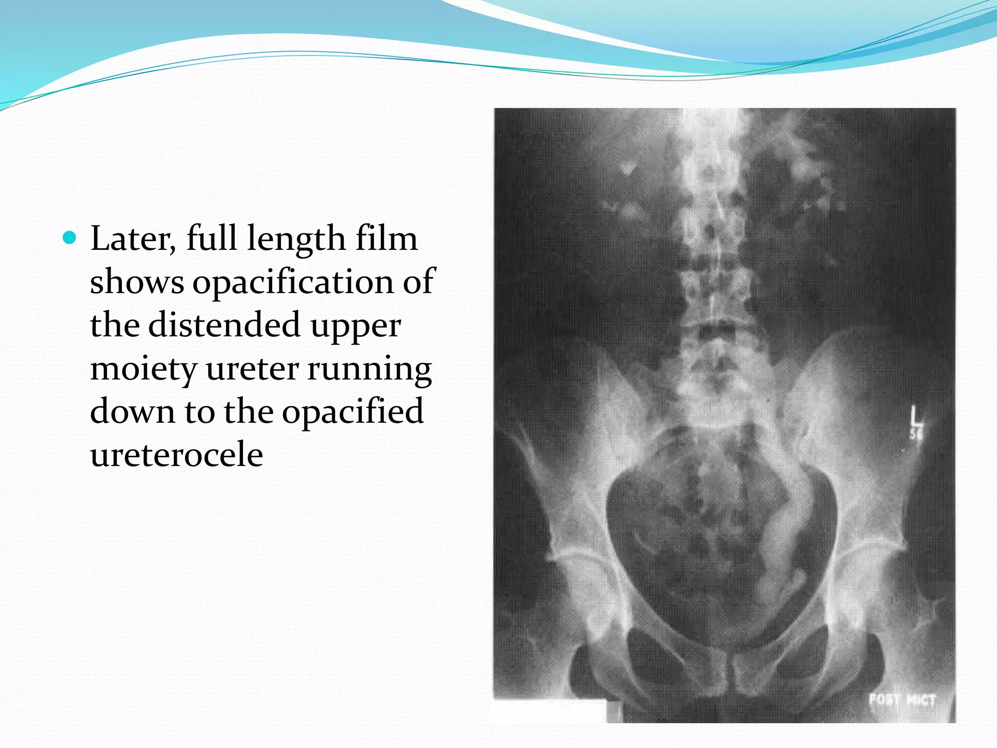  Later, full length film
shows opacification of
the distended upper
moiety ureter running
down to the opacified
ureterocele
 