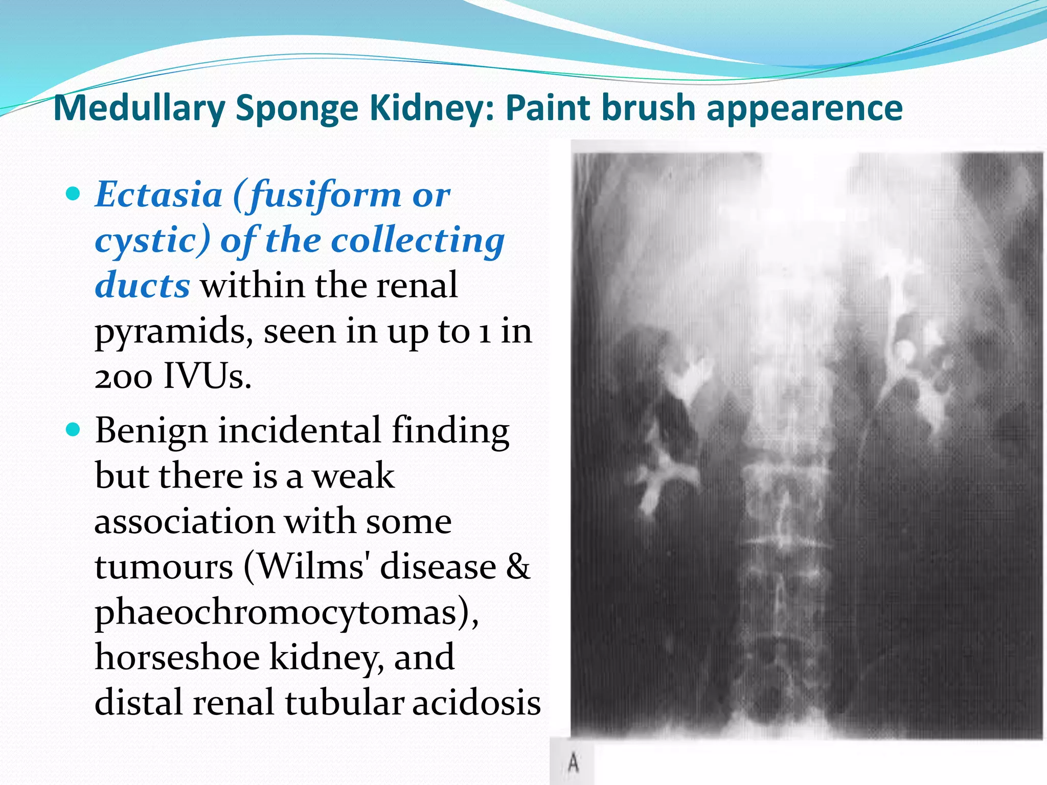 Medullary Sponge Kidney: Paint brush appearence
 Ectasia (fusiform or
cystic) of the collecting
ducts within the renal
pyramids, seen in up to 1 in
200 IVUs.
 Benign incidental finding
but there is a weak
association with some
tumours (Wilms' disease &
phaeochromocytomas),
horseshoe kidney, and
distal renal tubular acidosis
 