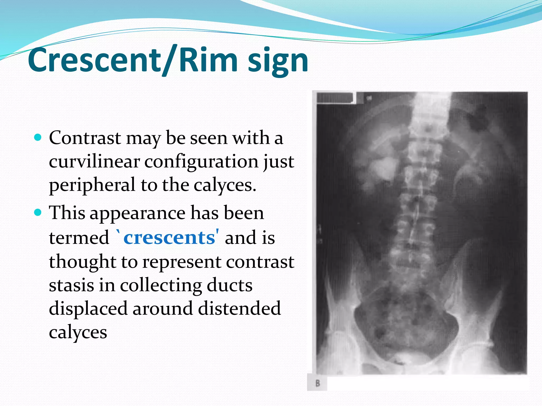 Crescent/Rim sign
 Contrast may be seen with a
curvilinear configuration just
peripheral to the calyces.
 This appearance has been
termed `crescents' and is
thought to represent contrast
stasis in collecting ducts
displaced around distended
calyces
 