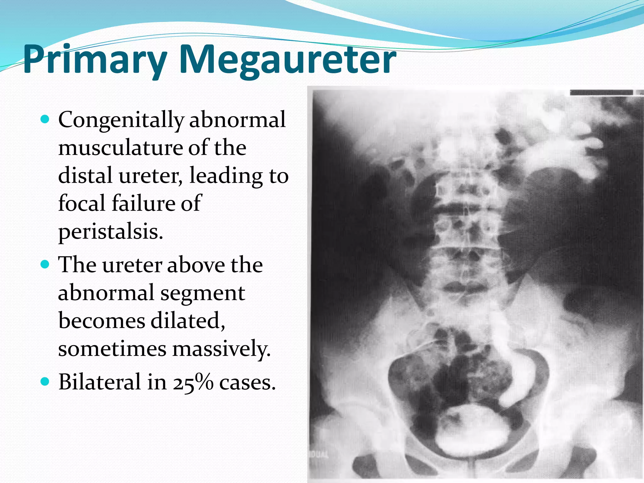 Primary Megaureter
 Congenitally abnormal
musculature of the
distal ureter, leading to
focal failure of
peristalsis.
 The ureter above the
abnormal segment
becomes dilated,
sometimes massively.
 Bilateral in 25% cases.
 