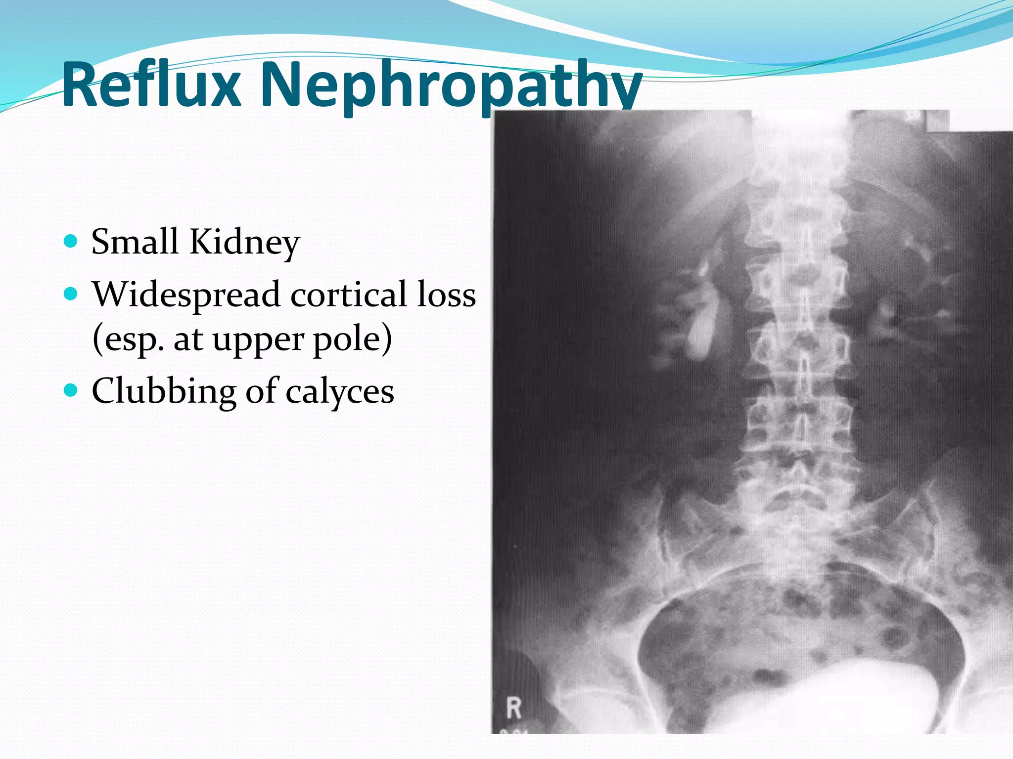 Reflux Nephropathy
 Small Kidney
 Widespread cortical loss
(esp. at upper pole)
 Clubbing of calyces
 