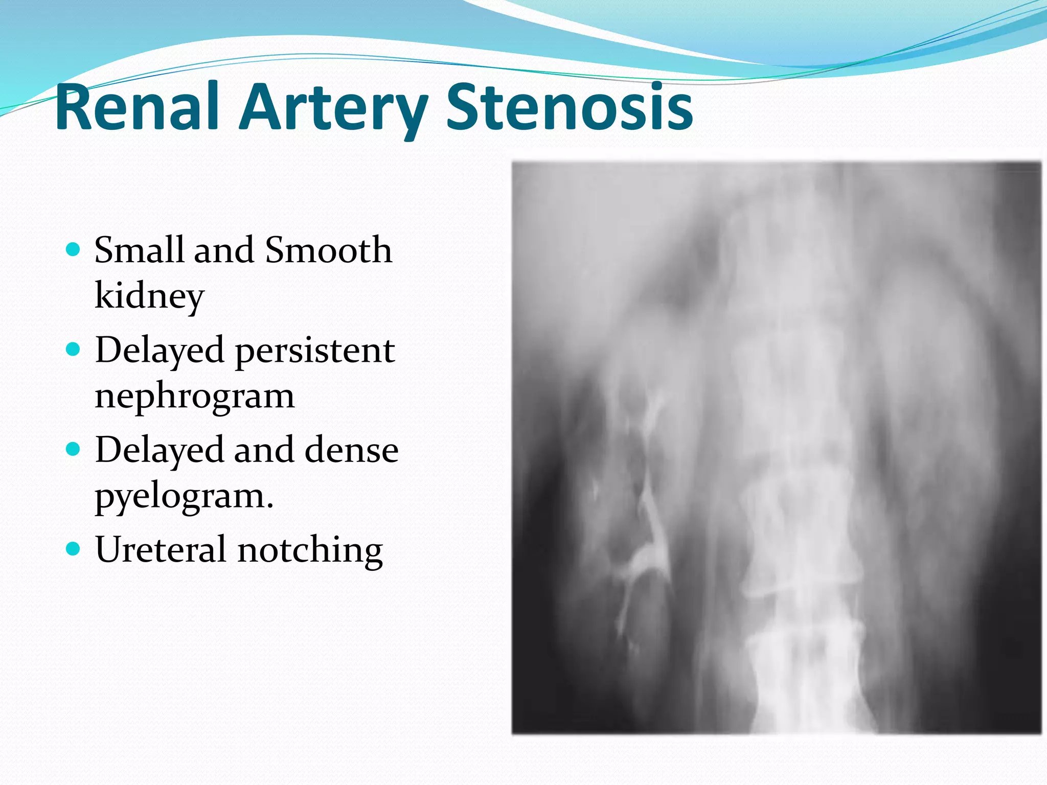  Small and Smooth
kidney
 Delayed persistent
nephrogram
 Delayed and dense
pyelogram.
 Ureteral notching
Renal Artery Stenosis
 