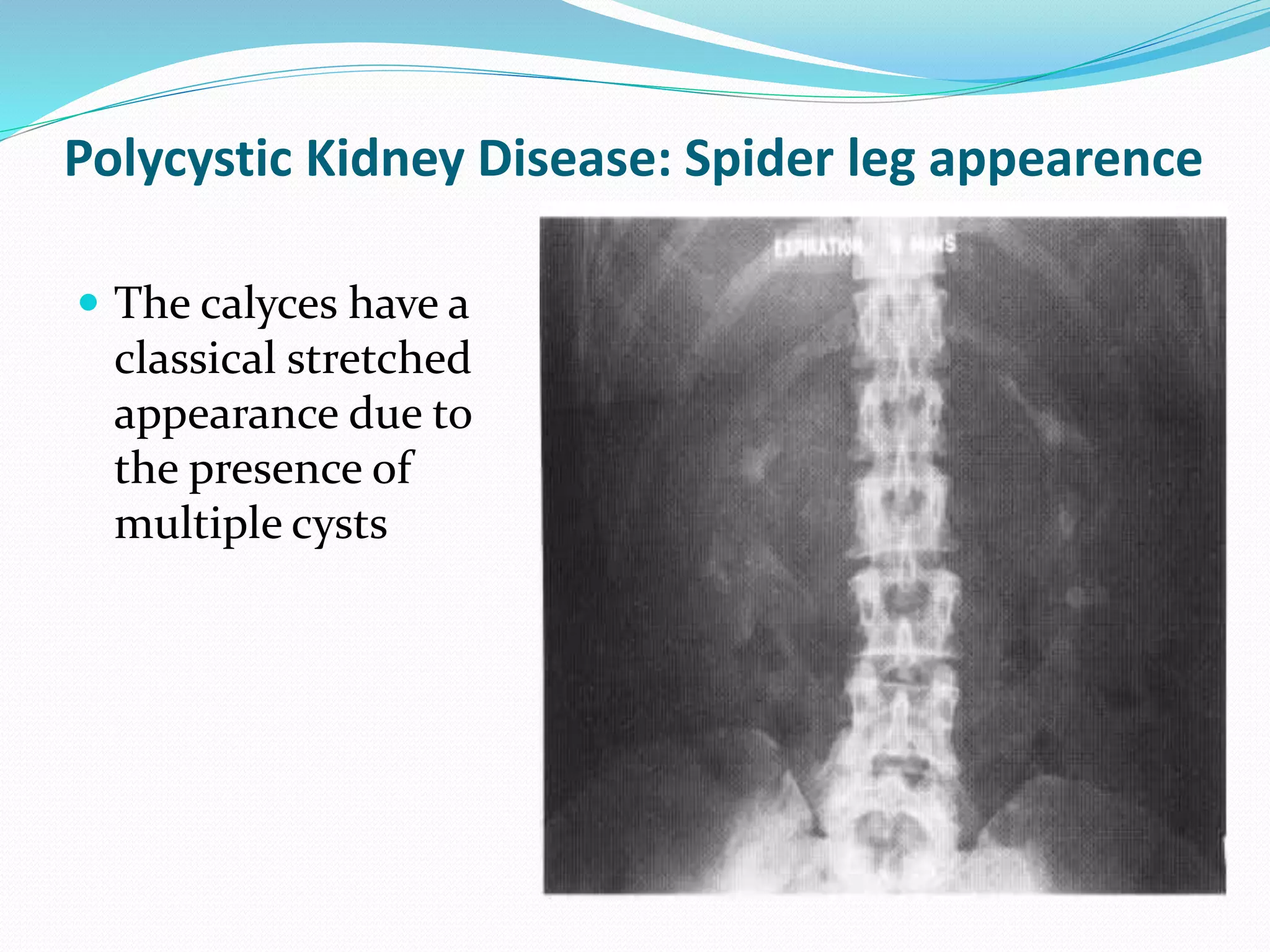 Polycystic Kidney Disease: Spider leg appearence
 The calyces have a
classical stretched
appearance due to
the presence of
multiple cysts
 