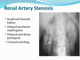 Pyelogram Vs Nephrogram Intravenous urography | PPT