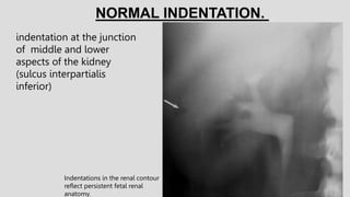indentation at the junction
of middle and lower
aspects of the kidney
(sulcus interpartialis
inferior)
NORMAL INDENTATION.
Indentations in the renal contour
reflect persistent fetal renal
anatomy.
 