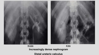 Increasingly dense nephrogram
Distal ureteric calculus
10 min 4 hrs
 