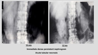Immediate dense persistent nephrogram
Acute tubular necrosis
10 min 12 hrs
 
