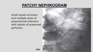 PAN
Small vessel occlusion
and multiple areas of
parenchymal infarction
with islands of preserved
perfusion.
PATCHY NEPHROGRAM
 