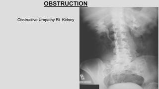OBSTRUCTION
Obstructive Uropathy Rt Kidney
 