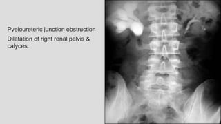 Pyeloureteric junction obstruction
Dilatation of right renal pelvis &
calyces.
 
