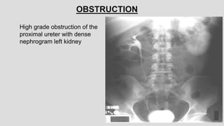 OBSTRUCTION
High grade obstruction of the
proximal ureter with dense
nephrogram left kidney
 