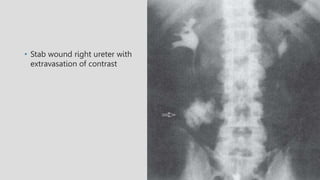 • Stab wound right ureter with
extravasation of contrast
 
