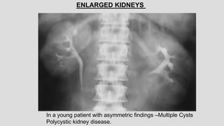 In a young patient with asymmetric findings –Multiple Cysts
Polycystic kidney disease.
ENLARGED KIDNEYS
 