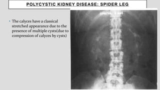 POLYCYSTIC KIDNEY DISEASE: SPIDER LEG
• The calyces have a classical
stretched appearance due to the
presence of multiple cysts(due to
compression of calyces by cysts)
 