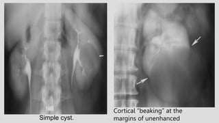Simple cyst.
Cortical “beaking” at the
margins of unenhanced
 